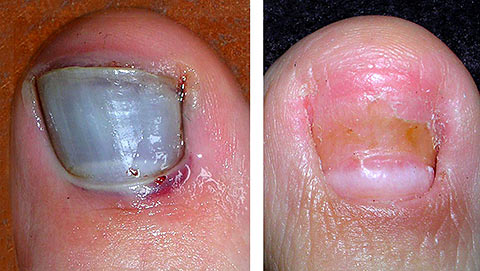 Black toe nails.