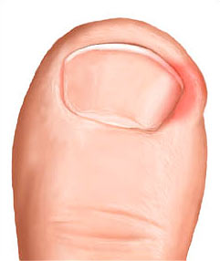Ingrown toe nail can be painful.