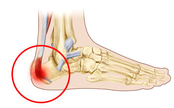 Calcaneal apophysitis.