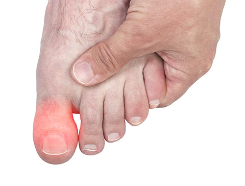 is Do pludselig Don't ignore big toe pain. - Dr. Howard Green