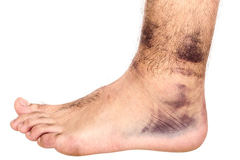 Symptoms of severe ankle sprains.
