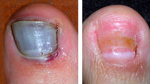 Fungal toe nails... or Onychomycosis