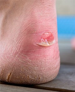 Blisters.