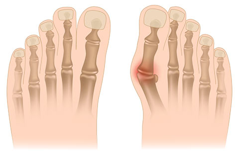 Normal foot (left) vs. bunion.