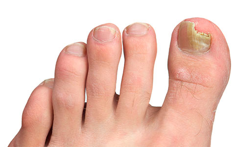 Typical fungal toe nail.