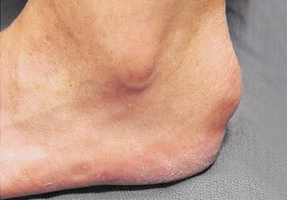 Heel bumps.