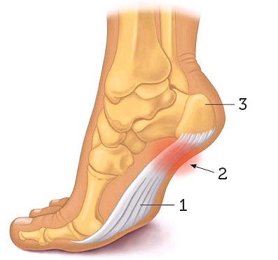 Heel pain: 1 — Plantar fascia; 2 — Area of pain; 3 — Heel bone (calcaneus).
