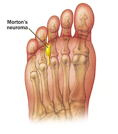 Morton's neuroma.