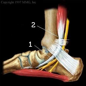 Posterior tibial tendonitis: 1— Posterior tibial nerve; 2 — Posterior tibial tendon.