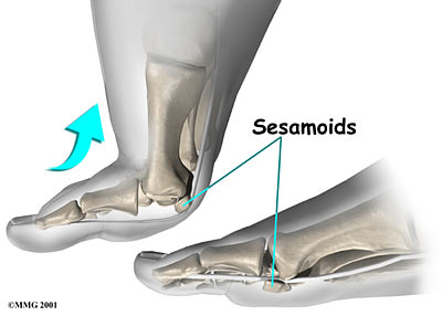 Sesamoiditis origins.