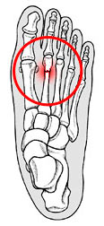 Stress fracture.