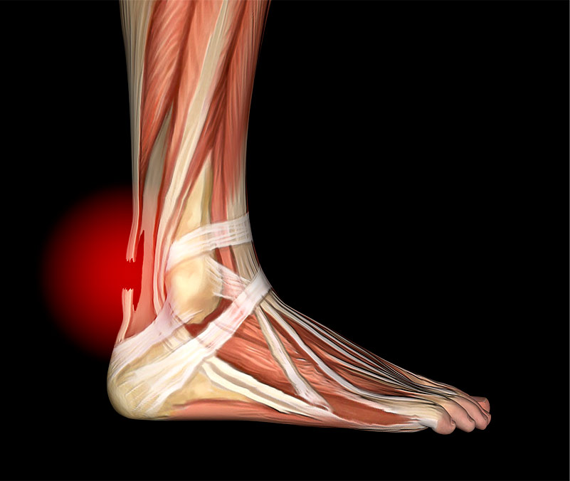 Achilles tendonitis.