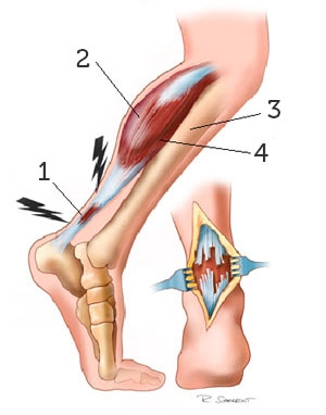Achilles tendonitis: 1 — Achilles tendon with inflammation; 2 — Castrochemius muscle; 3 — Tibia bone; 4 — Soleus muscle.