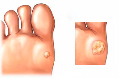 Warts caused by a virus.